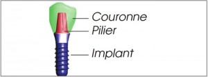L’implantologie