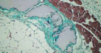 Des éponges d’acide hyaluronique pour aider la cicatrisation Dégradation