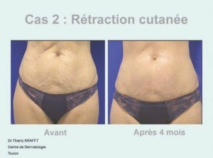 Rétraction cutanée