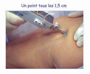 Point tous les 1,5cm