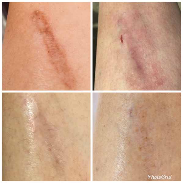 Cicatrice de jambe avant et après traitement laser