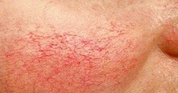 Laser, couperose, érythrose, et rougeurs du visage couperose