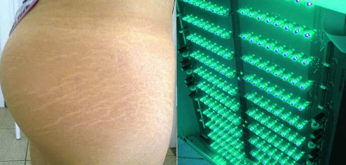 stool thief Malawi La photothérapie par lumière LED pour améliorer la peau - AFME | AFME