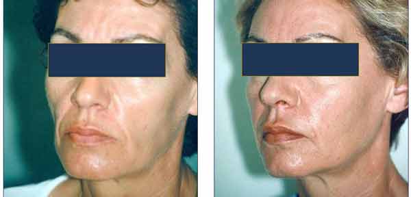 résultat remodelage visage de femme par injections