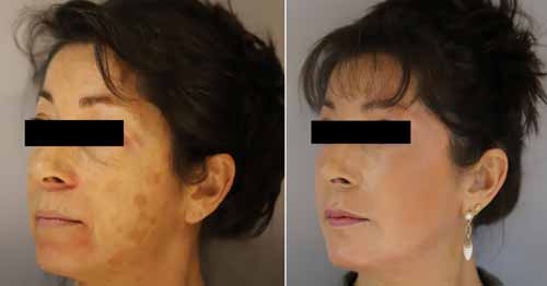 Photo peeling profond avant-apres