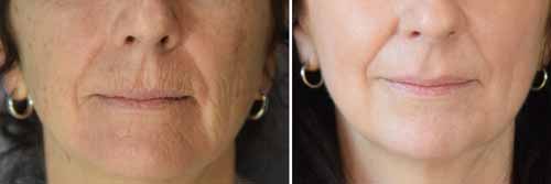 avant et apres peeling profond