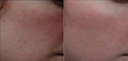 Peeling du visage superficiel (doux) : une peau renouvellée