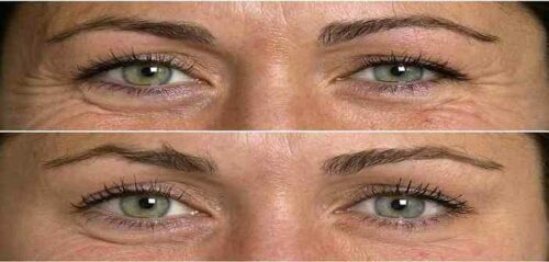 injection de botox