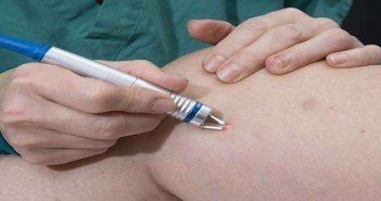 Laser vasculaire et traitement des vaisseaux ou varicosités Laser vasculaire