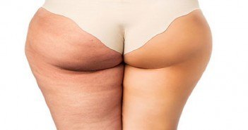 La cryolipolyse contre la cellulite (ou lipocryolyse) cellulite des fesses et cuisses