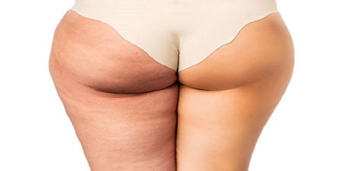 cellulite des fesses et cuisses