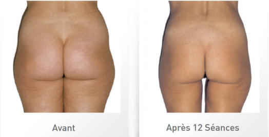 cellulite_stimulation_AVAP