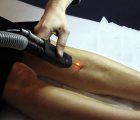 epilation au laser alexandrite