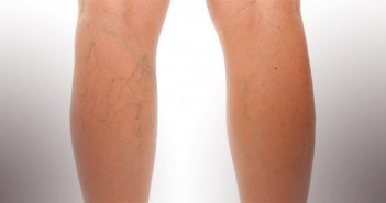 La phlébectomie esthétique varices et vaisseaux des jambes