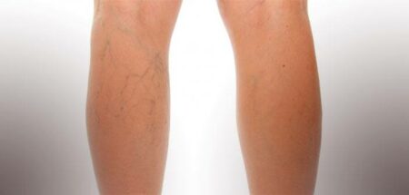 varices et vaisseaux des jambes