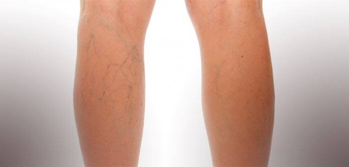 Traitement des varices par laser endoveineux | AFME