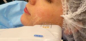 appareil à ultrasons sur le visage