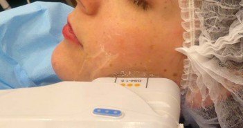 Les ultrasons focalisés contre le relachement cutané du visage (HIFU) appareil à ultrasons sur le visage