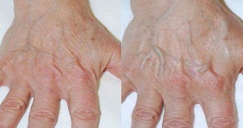 Combinaison acide hyaluronique + plasma riche en plaquettes, en mésothérapie mains après PRP et acide hyaluronique