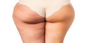 cellulite avant après