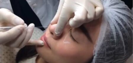 injection remodelante du nez