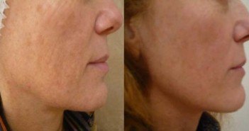 Rajeunissement du visage et du corps par fils tenseurs resorbables fils tenseurs de l'ovale du visage