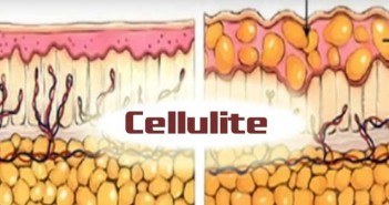 Cellulite fémorale : physiologie, techniques de prise en charge histologie cellulite
