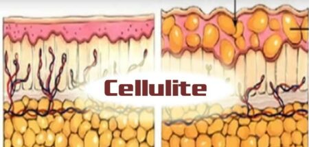 histologie cellulite