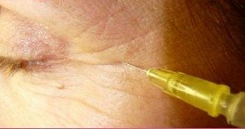 Les indications atypiques de la toxine botulique dans le visage Botulique