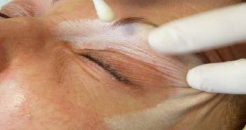 EXOPEEL 4 ans d’expérience personnelle avec le phénol exopeel