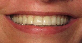 Esthétique gingivale en implantologie