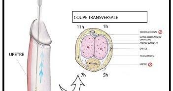 L’augmentation pénienne par acide hyaluronique