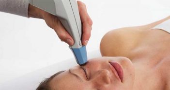 La nouvelle radiofréquence Exilis° : effet lifting sans chirurgie