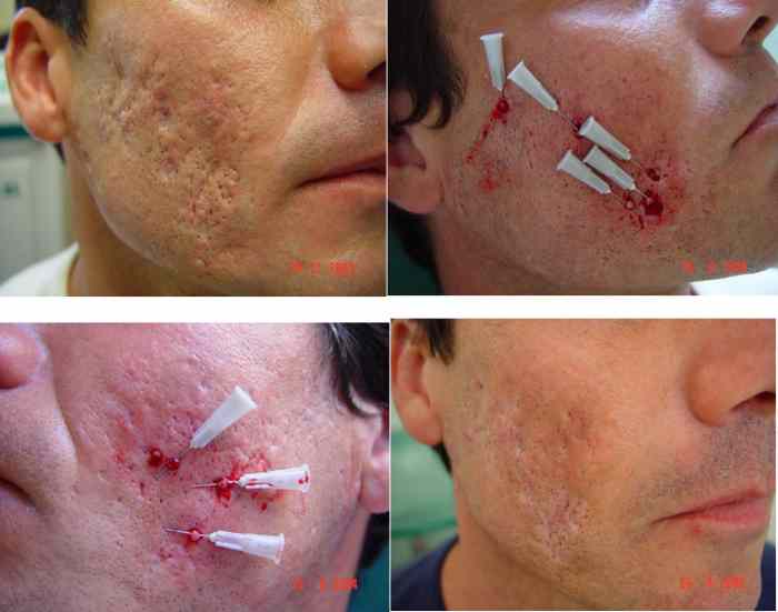 Traitement des vergetures et cicatrices au laser | AFME