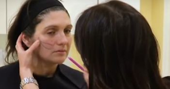 Fils tenseurs resorbables aptos : technique de pose Dessin de fils tenseurs sur le visage