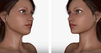 Le lifting du visage et du cou : Elasticum fils tenseurs cou retendu