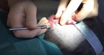 Micro-greffe capillaire FUE microgreffes prélèvement