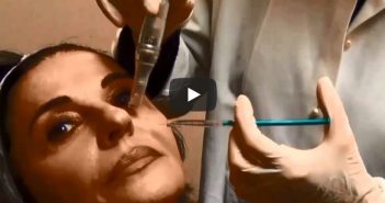 Microneedling
