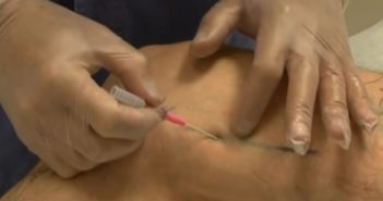 Traitement des varices par injection de mousse sclérosante