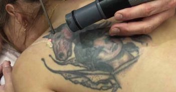 Detatouage au Laser Détatouage dans le dos