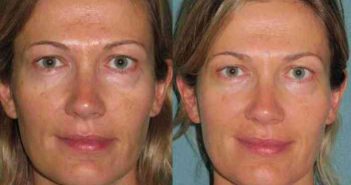 Radiance Peel®, un peeling gratifiant !