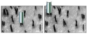 La greffe de cheveux (micro-greffes ou implants capillaires)