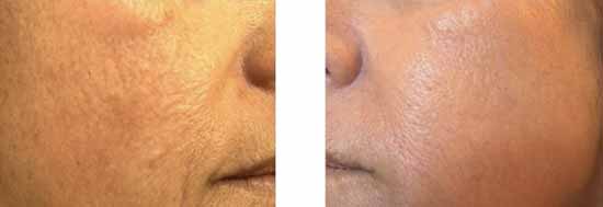 peau du visage avant et après laser de resurfacing