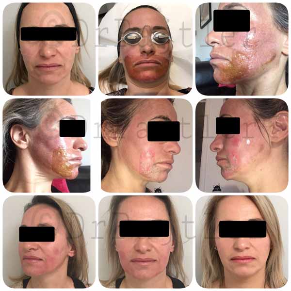 Traitement des rides du visage par laser abrasion (resurfacing)