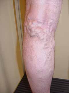 Varices sur jambe d'homme