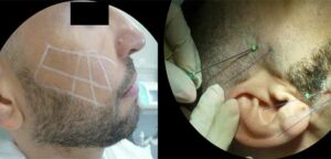 intervention de fils tenseurs sur un visage