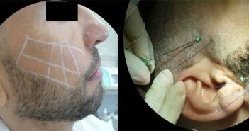 Les fils tenseurs chez l’homme intervention de fils tenseurs sur un visage