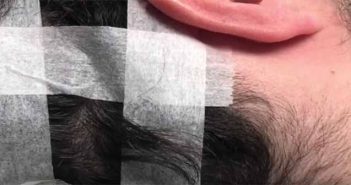 Autogreffe des cellules souches par technique Rigenera mesogreffe de cheveux