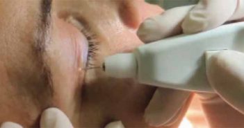 Le Plexr pour rajeunir un visage sans chirurgie