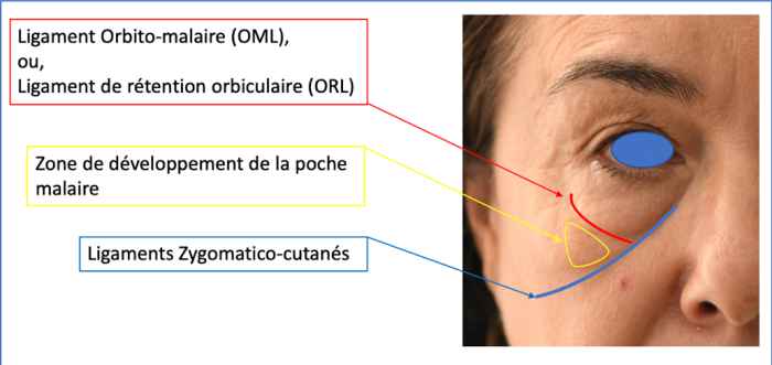 Poches Malaires Oedeme Lymphatique Sous L Oeil